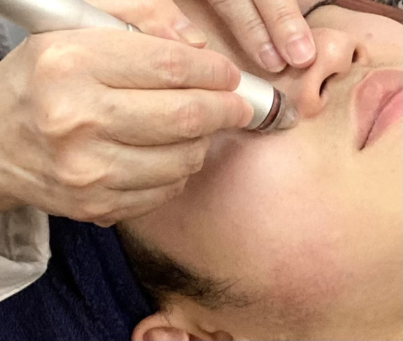 毛穴洗浄　施術風景