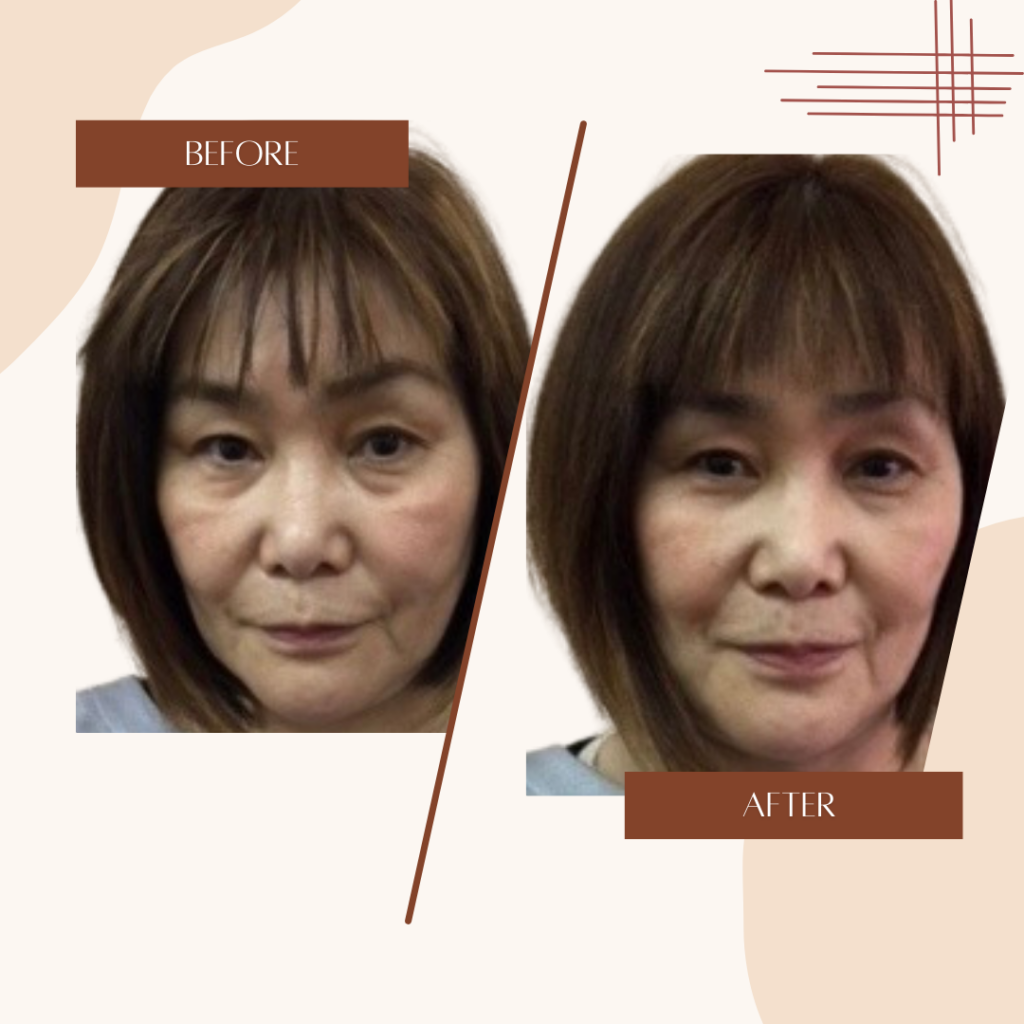 小顔リフトアップ　施術前・後