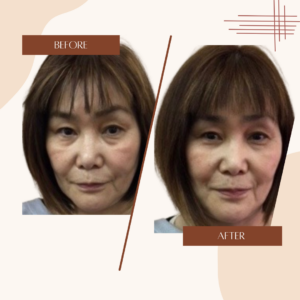 小顔リフトアップ　施術前・後